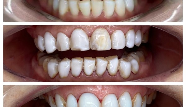 美容院牙贴面踩坑？齿艺美学铒激光帮你重获微笑