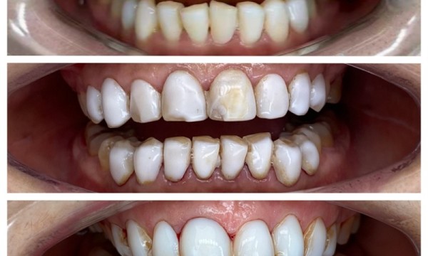 美容院牙贴面踩坑？齿艺美学铒激光帮你重获微笑